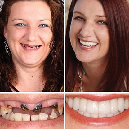 -Ends Today: 70% OFF! ⏰HazyGalaxy™  Medical Full Denture with Strong Suctiond Custom-Fit Full Functional Dentures🦷