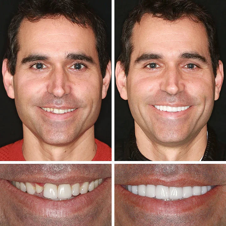 Ends Today: 70% OFF! ⏰DarkFairy™ Medical Full Denture with Strong Suctiond🦷