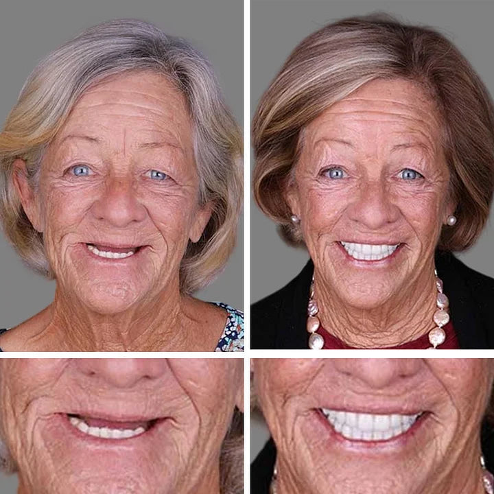 Ends Today: 70% OFF! ⏰DarkFairy™ Medical Full Denture with Strong Suctiond🦷