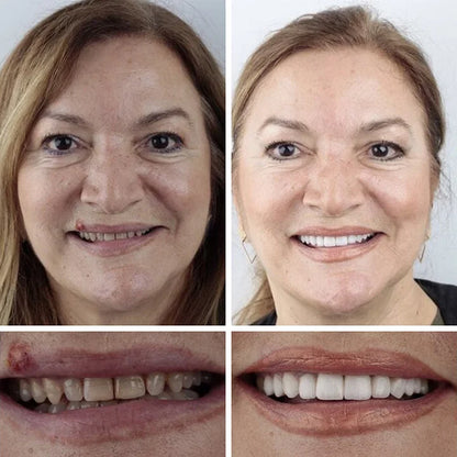🔥Ends Today: 75% OFF! ⏰DarkFairy™ Medical Full Denture with Strong Suctiond Custom-Fit Full Functional Dentures🦷