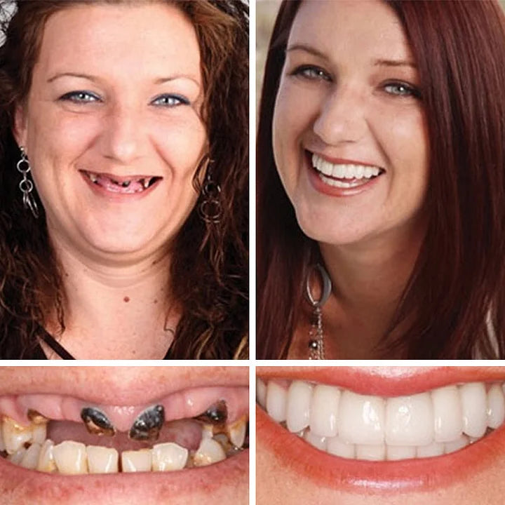Ends Today: 70% OFF! ⏰DarkFairy™ Medical Full Denture with Strong Suctiond🦷
